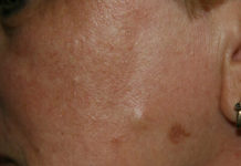 Жировик на щеке: как избавиться в домашних условиях, фото новообразования под кожей