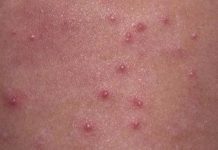 Как выглядит сыпь под мышками у взрослых? Причины