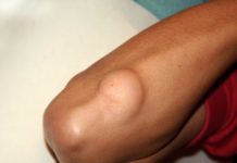 Этиология И Патогенез Липомы