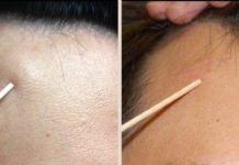 Жировик на лбу: причины появления и лечение