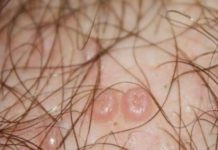 Пустула с гноем: причины возникновения, лечение заболеваний на лице и теле |