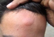 Жировик на лбу: как избавиться и убрать народными средствами, а также к какому врачу обратиться чтобы удалить, причины появления и фото