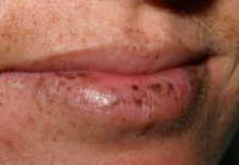 Чёрные и тёмные пятна на губах – фото, причины и как избавиться