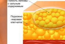 Липома молочной железы: классификация, симптомы, диагностика и лечение жировиков на груди
