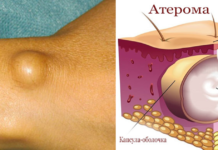 Мази от жировиков: обзор самых эффективных средств