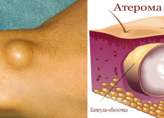 Мази от жировиков: обзор самых эффективных средств