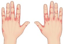 Сыпь на пальцах рук: причины возникновения и способы лечения