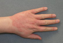 Сыпь на кистях рук: возможные причины, симптомы, проведение диагностических исследований, консультация врача и лечение