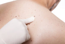 Черные пятна на теле: возможные причины, симптомы, проведение диагностических исследований, консультация врача и лечение