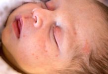 Сыпь вокруг глаз у ребенка: возможные причины, симптомы, необходимая диагностика, варианты лечения, фото