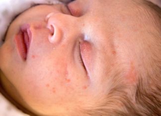 Сыпь вокруг глаз у ребенка: возможные причины, симптомы, необходимая диагностика, варианты лечения, фото