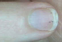 Черные пятна на ногтях рук: описание, причины появления, проведение анализов, лечение и консультация специалистов