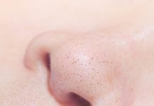 Как избавиться от черных точек на носу: методы и эффективные средства