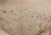 После депиляции появились гнойные прыщи, что делать?