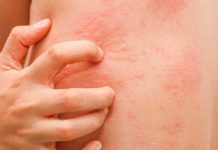 Аллергические поражения кожи