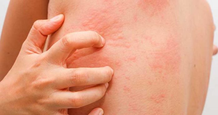 5-Natural-Cures-For-Chafing