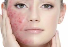 Правильное лечение акне: эффективные способы и средства от угревой болезни