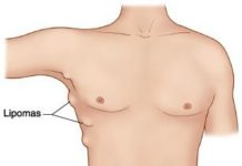 Липома — причины возникновения и методы лечения