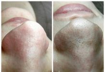 Чистка лица: все виды, противопоказания, плюсы и минусы