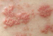 Красные пятна с пузырьками на коже: разновидности образований, их особенности и причины появления, сопутствующие симптомы и локализация, методы лечения и меры профилактики