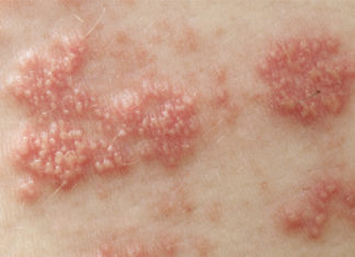 Красные пятна с пузырьками на коже: разновидности образований, их особенности и причины появления, сопутствующие симптомы и локализация, методы лечения и меры профилактики