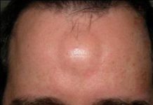 Липома на лбу у женщины: как избавиться в домашних условиях