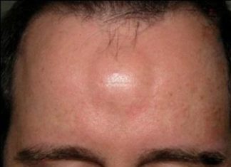 Липома на лбу у женщины: как избавиться в домашних условиях