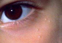 Уплотнения под кожей в виде шариков, что это