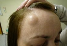 Что делать, если у вас жировик на лбу? Способы, как быстро избавиться