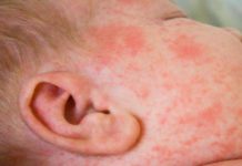 Сыпь на лице у грудничка: причины высыпаний, лечение заболеваний