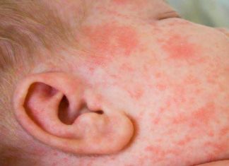 Сыпь на лице у грудничка: причины высыпаний, лечение заболеваний