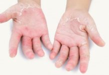 Как выглядит сыпь при псориазе