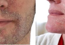 Жирная кожа шелушится — причины и уход