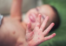 Герпес на глазу – фото, лечение и симптомы, поражение век (блефарит)