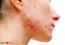 Акне — причины, симптомы, лечение и профилактика