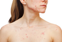 Высыпания на груди у женщин – обычное явление или признак патологии?