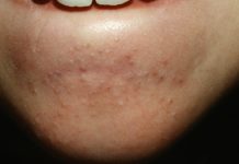 Как избавиться от черных точек – используем проверенные народные методы