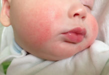 Красная шершавая сыпь у грудничка