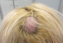 Жировик на голове — удаление липомы под кожей головы, причины, лечение