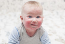 Атопический дерматит у детей