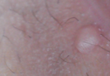 На какие высыпания на половых губах нужно обратить особое внимание? | У гинеколога