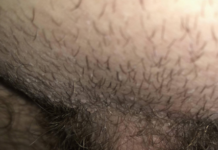 Какая сыпь в паху не должна пугать мужчину?