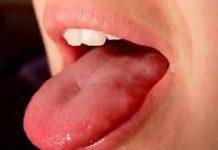 Почему могут появляться красные и белые пупырышки на языке у горла?