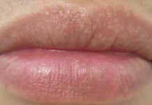 Белые точки на губах, мелкие прыщики, пупырышки