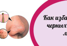 Черные точки на лице: причины, как избавиться в домашних условиях