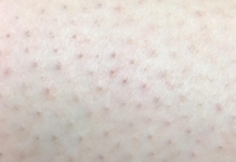 Можно ли выдавливать черные точки на ногах? | Мои Ноги