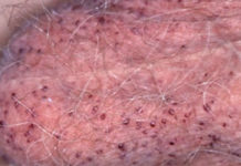 Черные точки на мошонке, фото, все причины и лечение