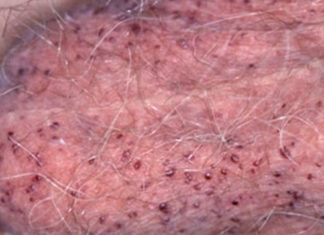 Черные точки на мошонке, фото, все причины и лечение