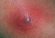 Чири – причины и симптомы чириев, диагностика, лечение и профилактика