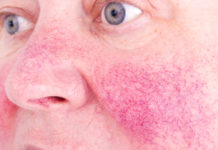 Жжение кожи: причины, лечение — Сыпи(высыпания)